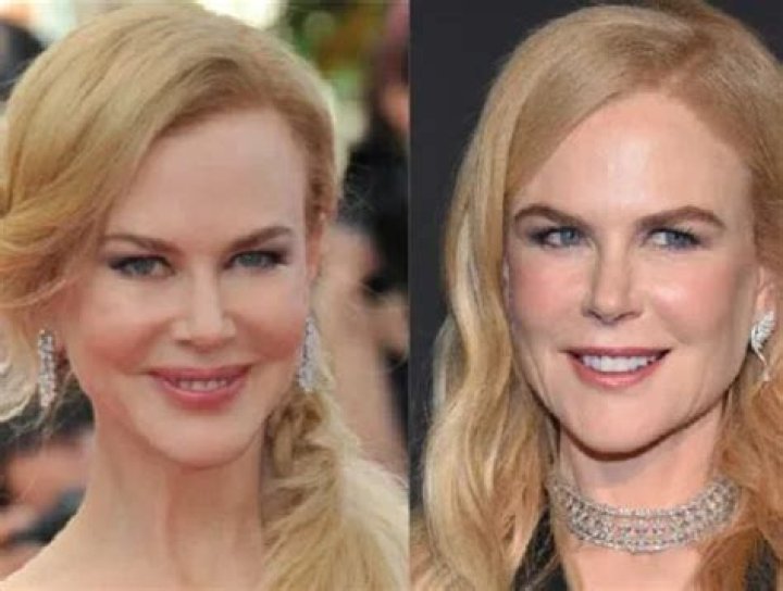Enhance Your Beauty: Nicole Kidman's Transformative Rhinoplasty Journey