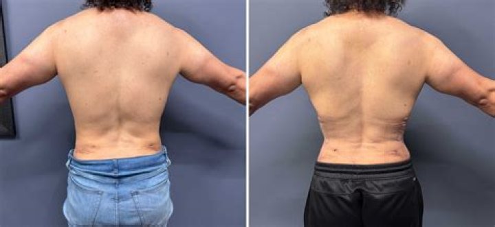 Transforming Silhouettes: Exploring Rib Surgery For A Smaller Waist